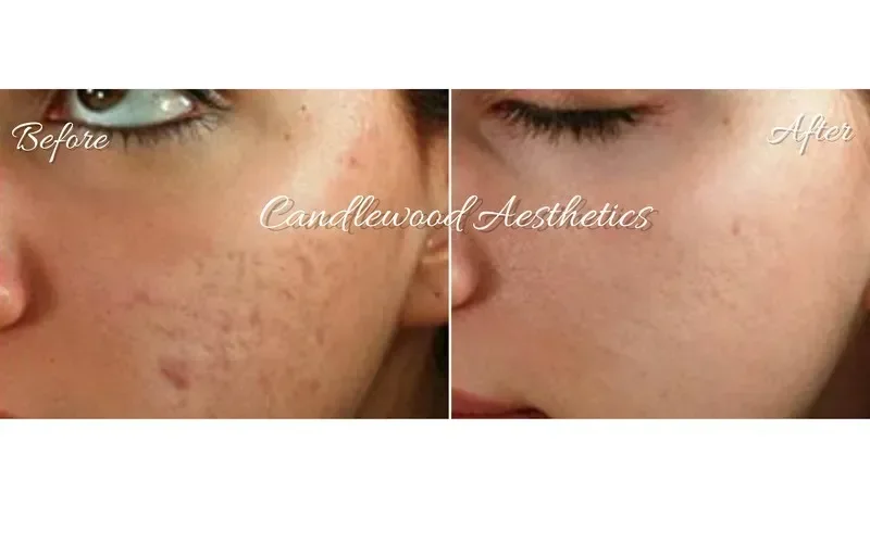 Comparison image showing the before and after effects of skincare, with clearer skin in the after photo.