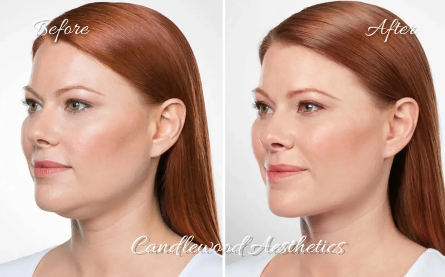 Side-by-side comparison of a woman before and after cosmetic treatment, showing improved skin appearance and facial features.