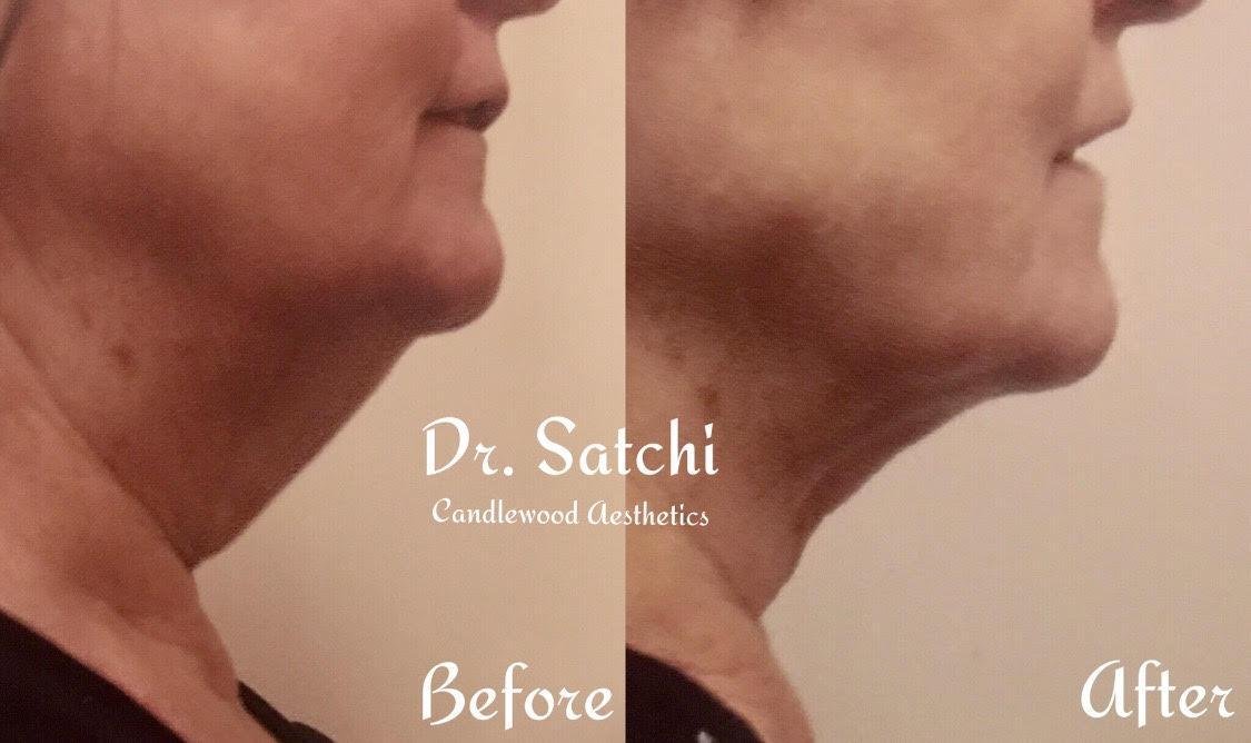 Side-by-side comparison of a woman's chin and jawline before and after cosmetic treatment, showing improved contour and reduced sagging.
