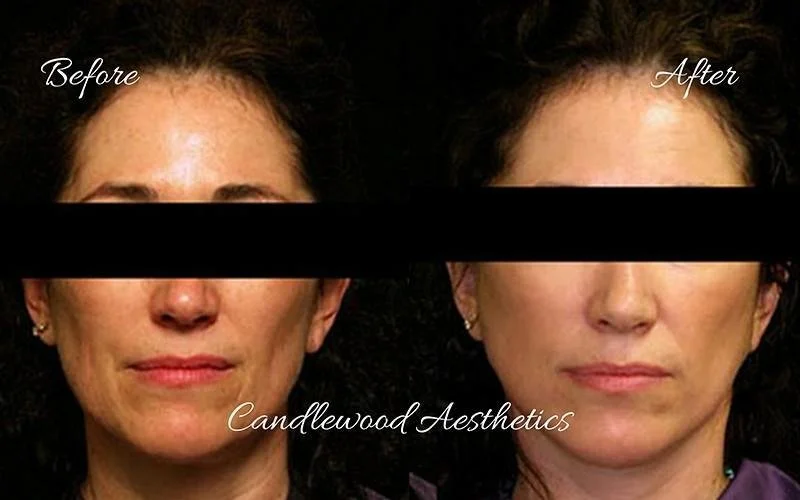 Side-by-side comparison of a woman's face before and after cosmetic treatment, showing smoother skin and reduced wrinkles after.