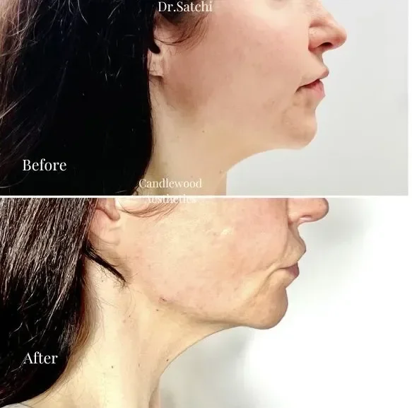 Side-by-side comparison of a woman's chin and neck area before and after cosmetic treatment, showing improvement in skin tightness and reduction of sagging.