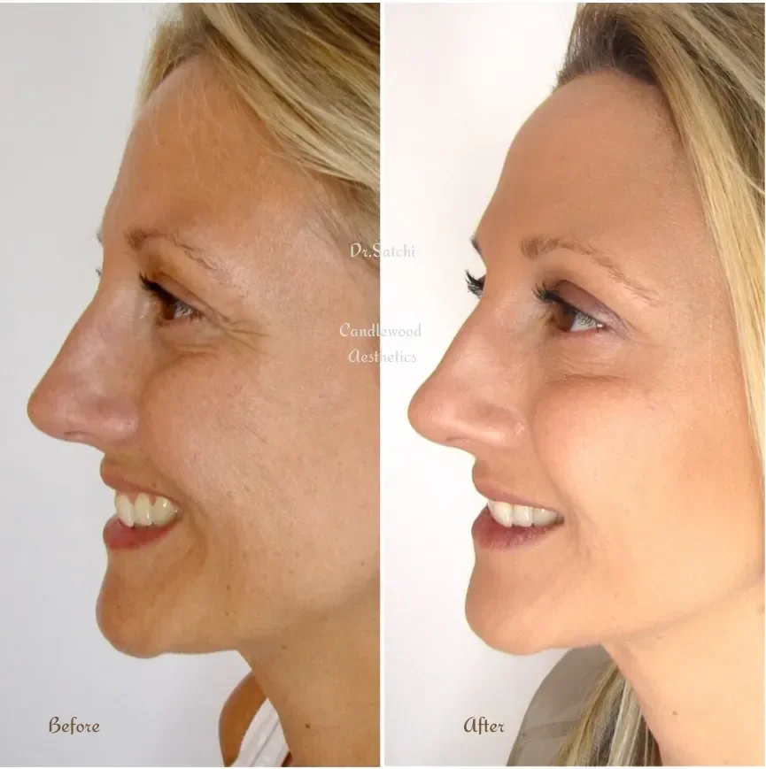 Side-by-side comparison of a woman's face before and after cosmetic treatment, showing improved skin smoothness and a more defined nose.