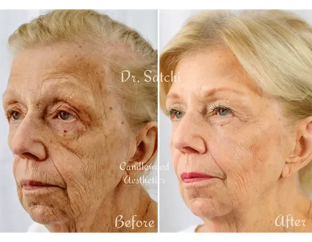 Side-by-side comparison of an elderly woman before and after cosmetic treatment, showing improved skin texture and appearance in the after photo.