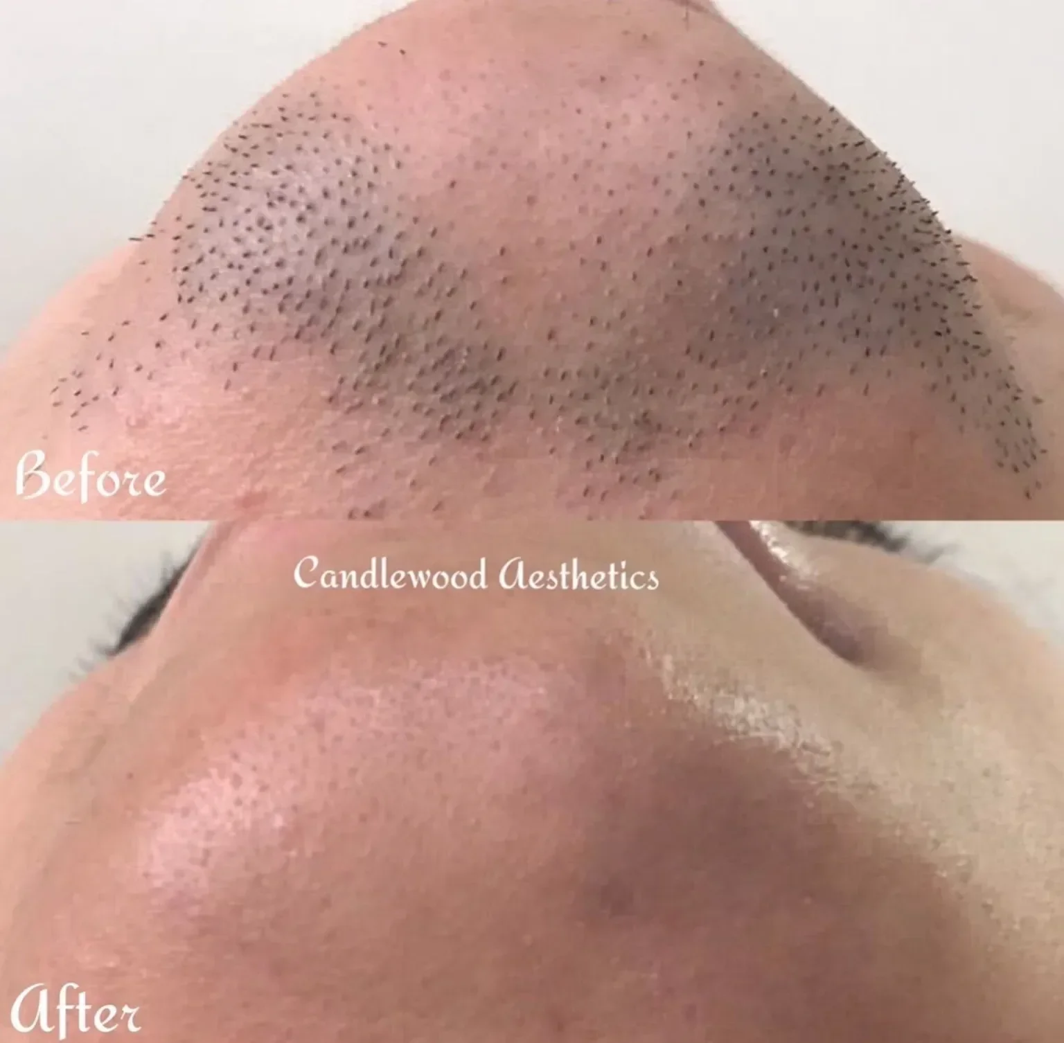 Comparison of a person's forehead before and after a cosmetic treatment, with visible reduction in redness and pore size, labeled 'Before' and 'After'.