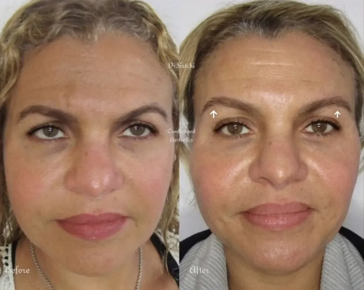 A side-by-side comparison photo showing a woman before and after cosmetic treatment. The woman has light skin, blonde hair, and brown eyes. The before image shows her with uneven skin tone and some skin imperfections. The after image shows her with smoother, clearer skin, and a more even complexion.