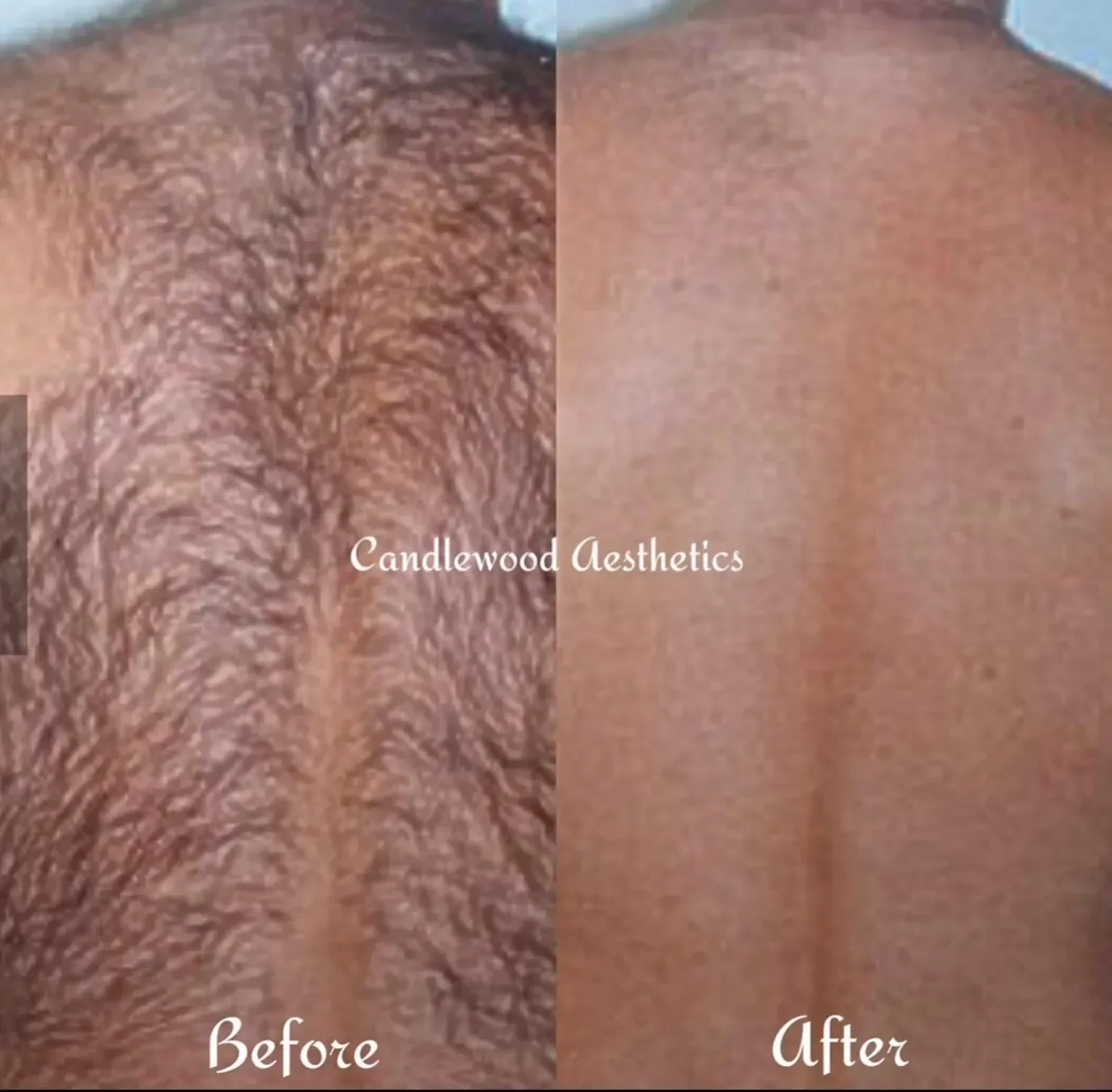 Comparison of skin on the back before and after treatment: left side shows skin with stretch marks or scars, right side shows smooth skin after treatment.