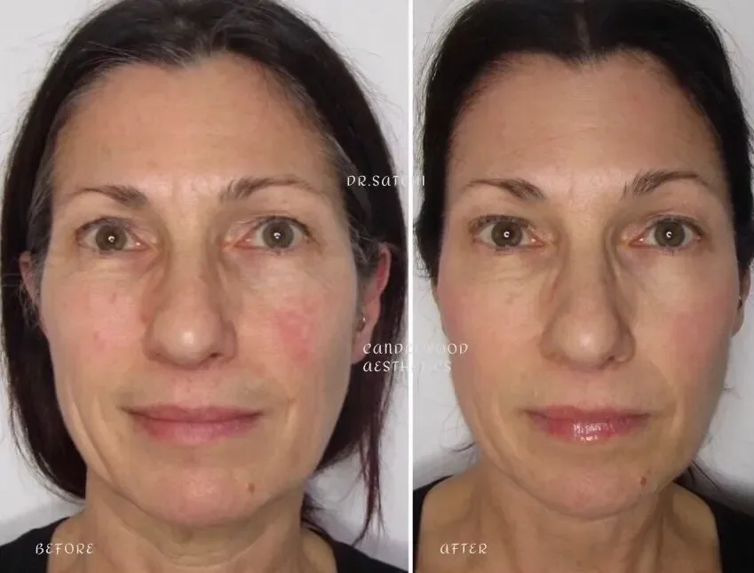 Side-by-side comparison of a woman before and after cosmetic treatment, showing improved skin texture and tone.