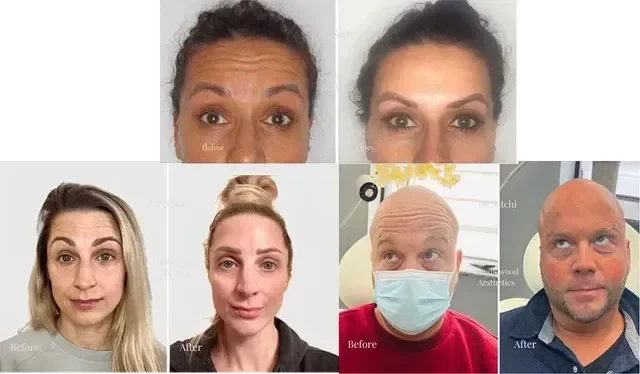 BOTOX FOREHEAD