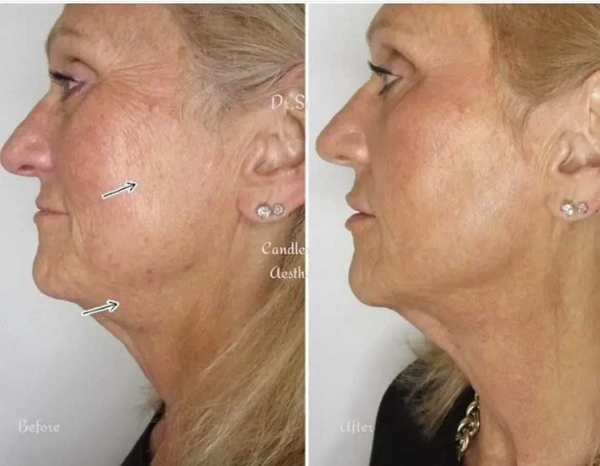Side-by-side comparison of a woman's face before and after a cosmetic procedure, showing reduced wrinkles and tightened skin around the jawline.