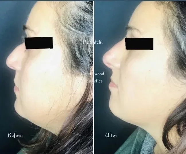 Side-by-side comparison of a woman's profile before and after a cosmetic procedure, showing a more defined jawline and altered facial profile in the after image.
