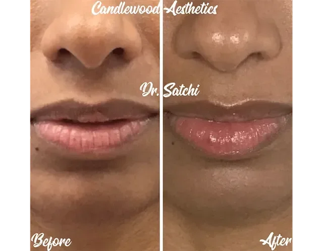 Close-up of a person's lips and nose showing a before and after comparison of a cosmetic treatment, with text overlays 'Candlewood Aesthetics,' 'Dr. Satchi,' 'Before,' and 'After.'