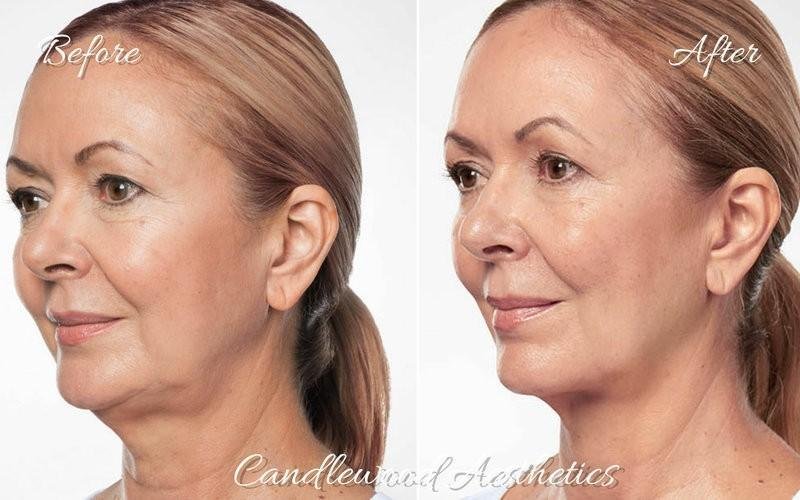 Side-by-side comparison of a woman before and after cosmetic treatment, showing smoother skin and reduced wrinkles in the 'after' image.