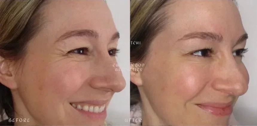 Close-up side profiles of a woman before and after skincare or cosmetic treatment, showing improved skin texture and appearance.