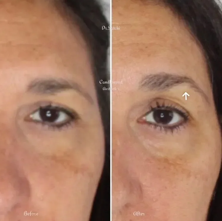 Close-up of a woman's eye showing wrinkles and dark circles on the left side labeled 'Before,' and fewer wrinkles and less dark circles on the right side labeled 'After,' indicating a skincare improvement.