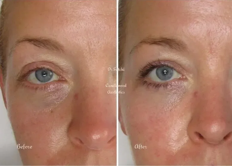 Side-by-side comparison of a woman's face showing the before and after effects of a skincare treatment, focusing on under-eye area with improved skin texture and reduced pigmentation after treatment.