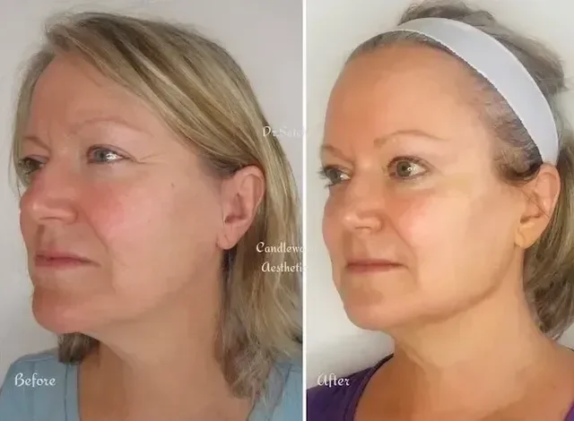 Side-by-side comparison of a woman before and after a skincare or cosmetic treatment. The before image shows her with slightly dull skin, while the after image shows her with a more radiant complexion, wearing a headband.