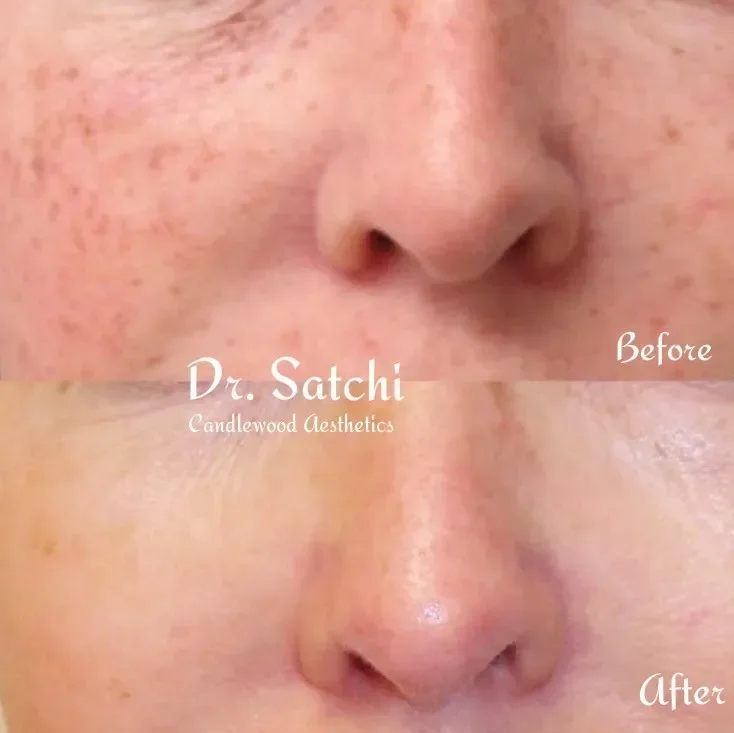 Close-up of a person's nose and surrounding skin, showing before and after skin treatment results with smoother skin in the 'after' section.