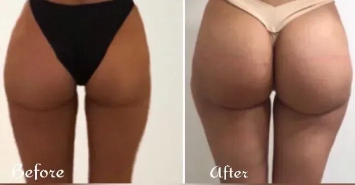 Comparison of a woman's buttocks before and after a cosmetic treatment or exercise, showing improvement in skin texture and shape.