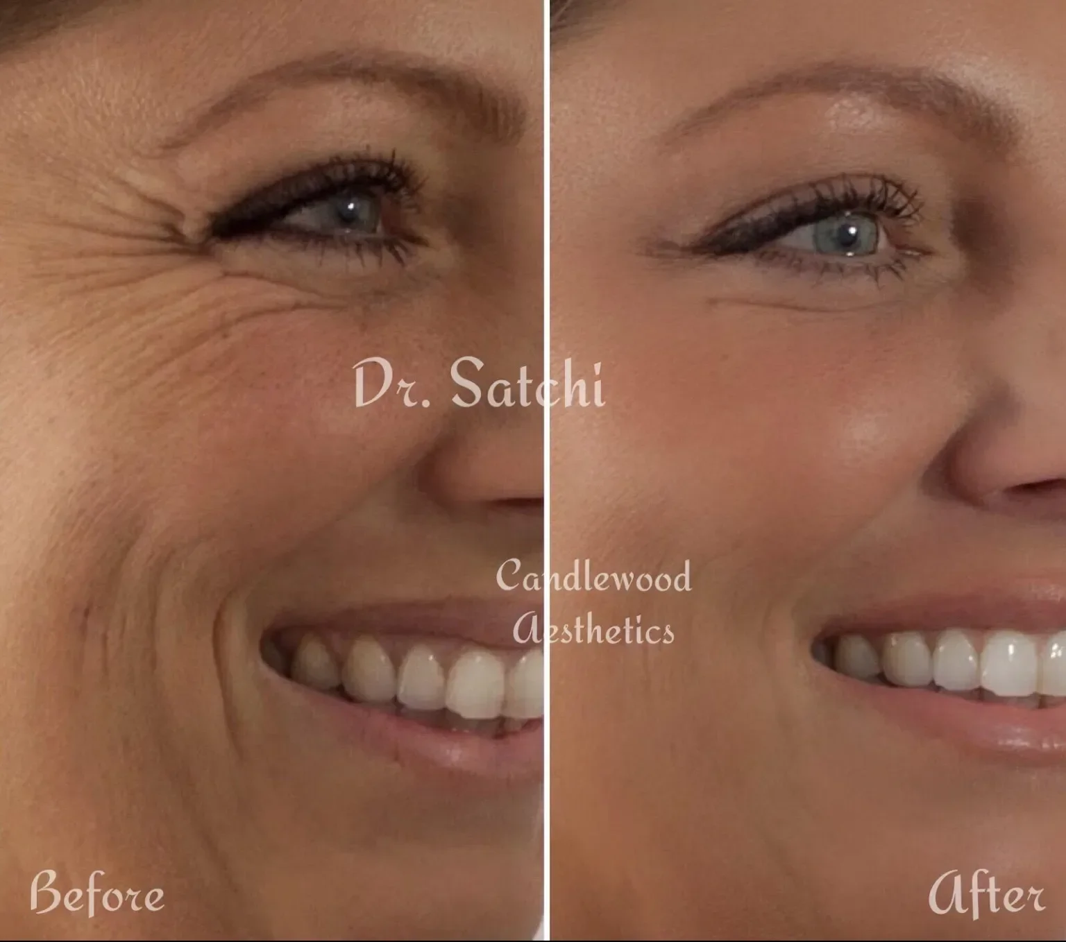 Side-by-side comparison of a woman's face showing before and after cosmetic treatment, highlighting reduced wrinkles and smoother skin around the eye and cheek areas.