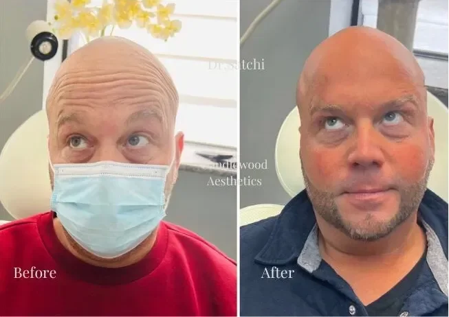 Comparison of a man's face before and after cosmetic treatment. In the 'before' image, he is wearing a face mask and a red shirt, with a bald head and visible wrinkles on his forehead. In the 'after' image, he is not wearing a mask, has a smoother ap