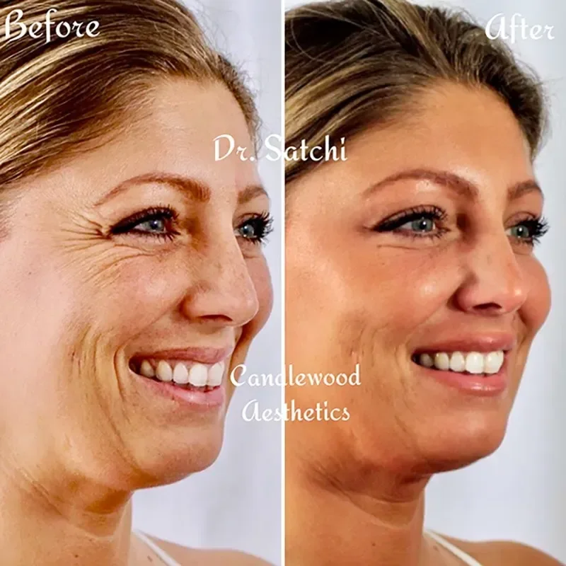 Side-by-side comparison of a woman before and after facial aesthetic treatment showing reduced wrinkles and smoother skin.