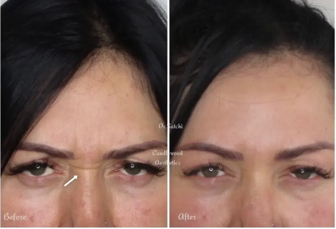 Side-by-side comparison of a woman's forehead and eye area before and after cosmetic treatment, showing reduced wrinkles and smoother skin.