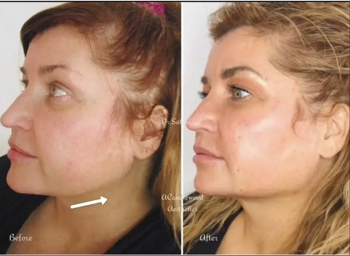Side-by-side comparison of a woman's face before and after a skin treatment, showing improved skin tone and texture.
