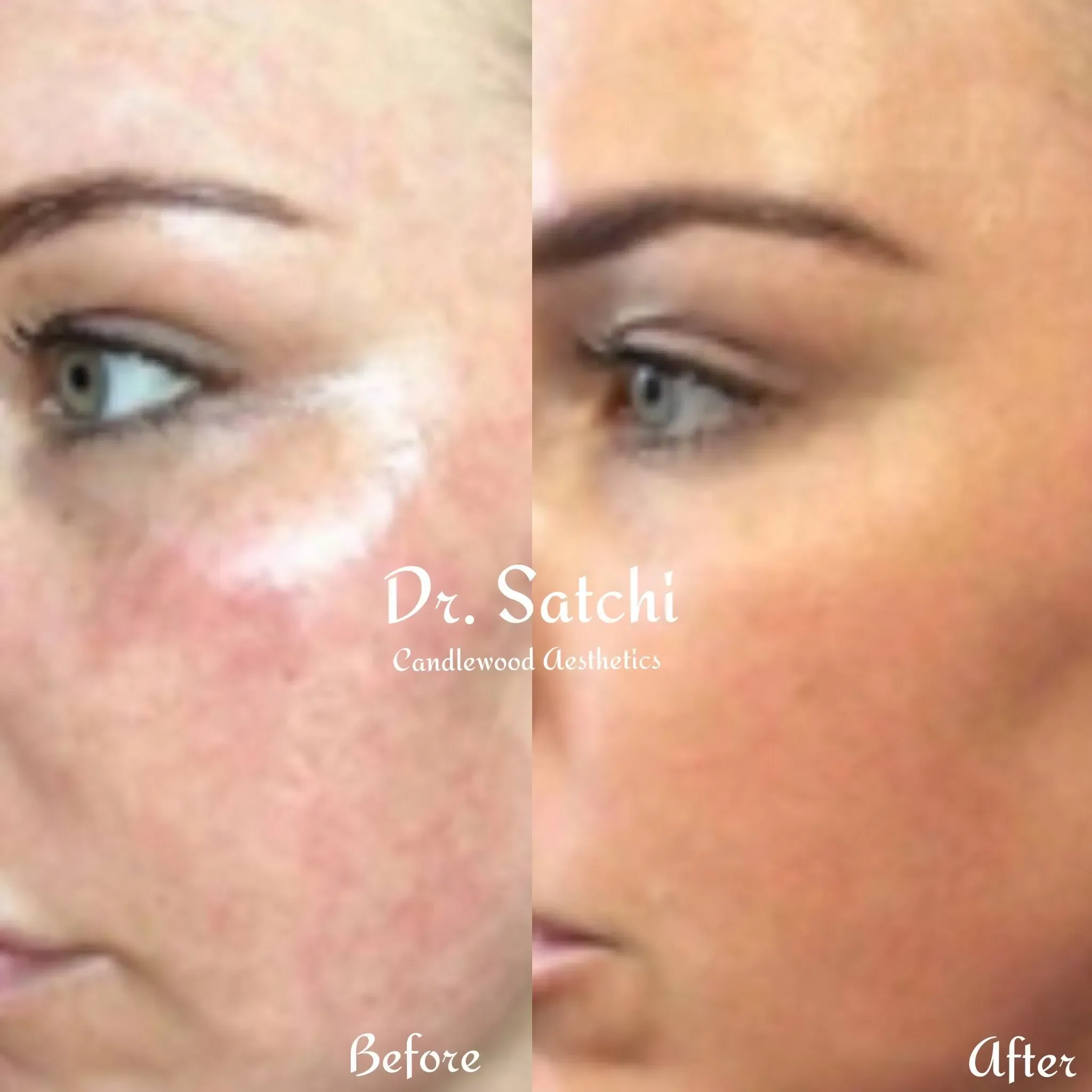 Side-by-side comparison of a woman's face before and after skincare treatment, showing improved skin clarity and texture.