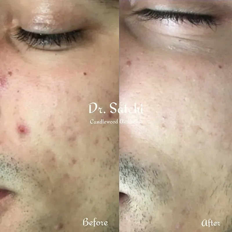Side-by-side comparison of a person's face showing skin improvements. The 'before' side has acne and redness, while the 'after' side shows clear, smoother skin.