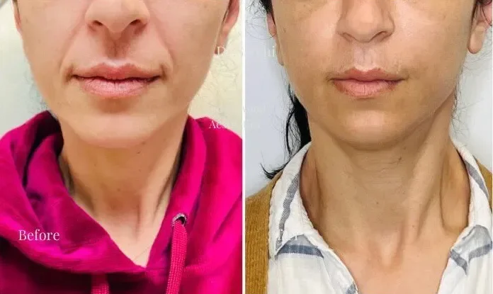 Side-by-side comparison of a woman's lower face and neck showing before and after apparent skincare treatment, with the woman wearing a pink hoodie in the "before" image and a striped shirt in the "after" image.