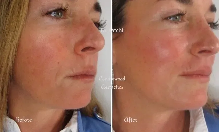 Side-by-side comparison of a woman's face showing skin before and after a skincare treatment. The left shows her skin with visible redness and uneven texture, and the right shows improved, clearer skin with reduced redness and smoother appearance.