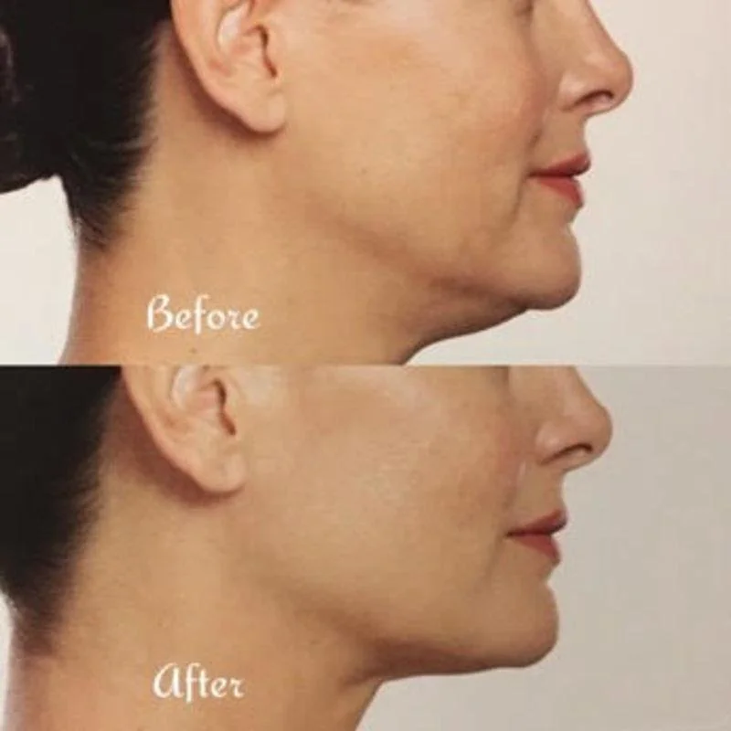 Side-by-side comparison of a woman's profile showing a reduction in submental fat and a more defined jawline after treatment.