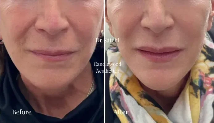 BOTOX LIP FLIP