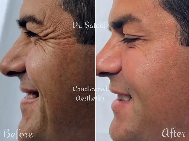 Side-by-side comparison of a man's face showing a 'before' and 'after' transformation, highlighting reduced wrinkles and smoother skin after cosmetic treatment.