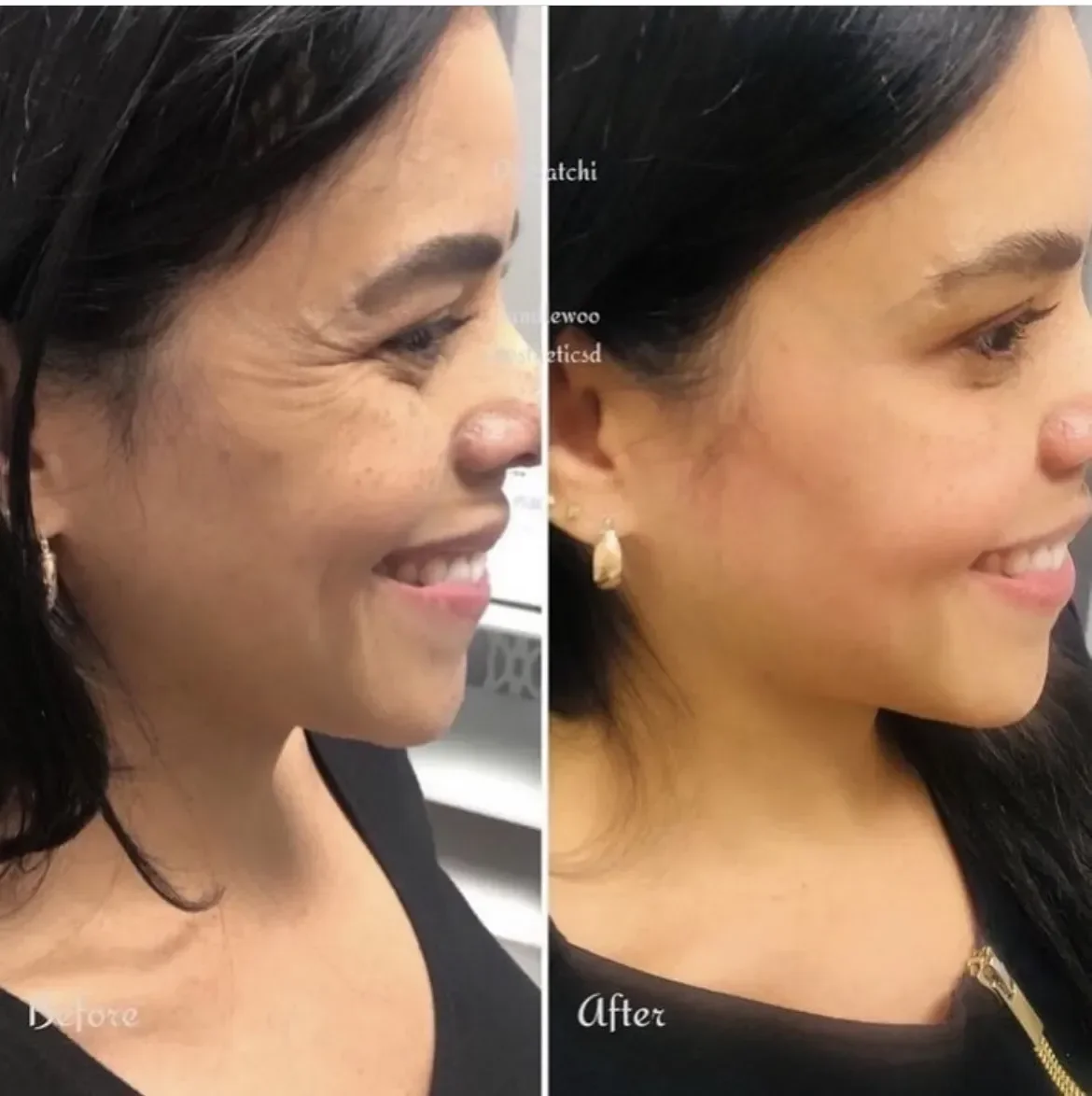Side-by-side comparison of a woman's face before and after cosmetic treatment, highlighting improved skin texture and reduced wrinkles.
