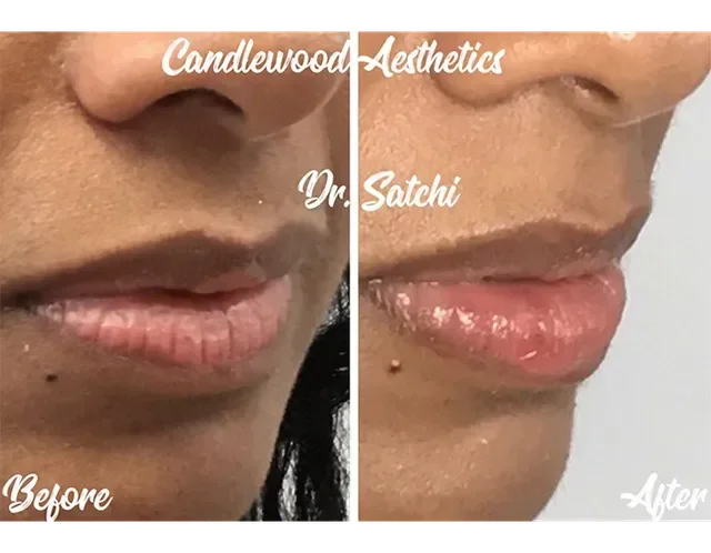 Close-up comparison of lips before and after cosmetic treatment, showing fuller and glossier lips in the after photo, with the text 'Candlewood Aesthetics', 'Dr. Satchi', 'Before', and 'After'.