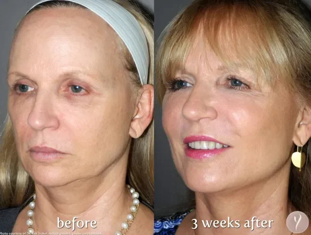Comparison photo showing a woman before and three weeks after cosmetic treatment, with significant skin improvement and makeup in the 'after' image.