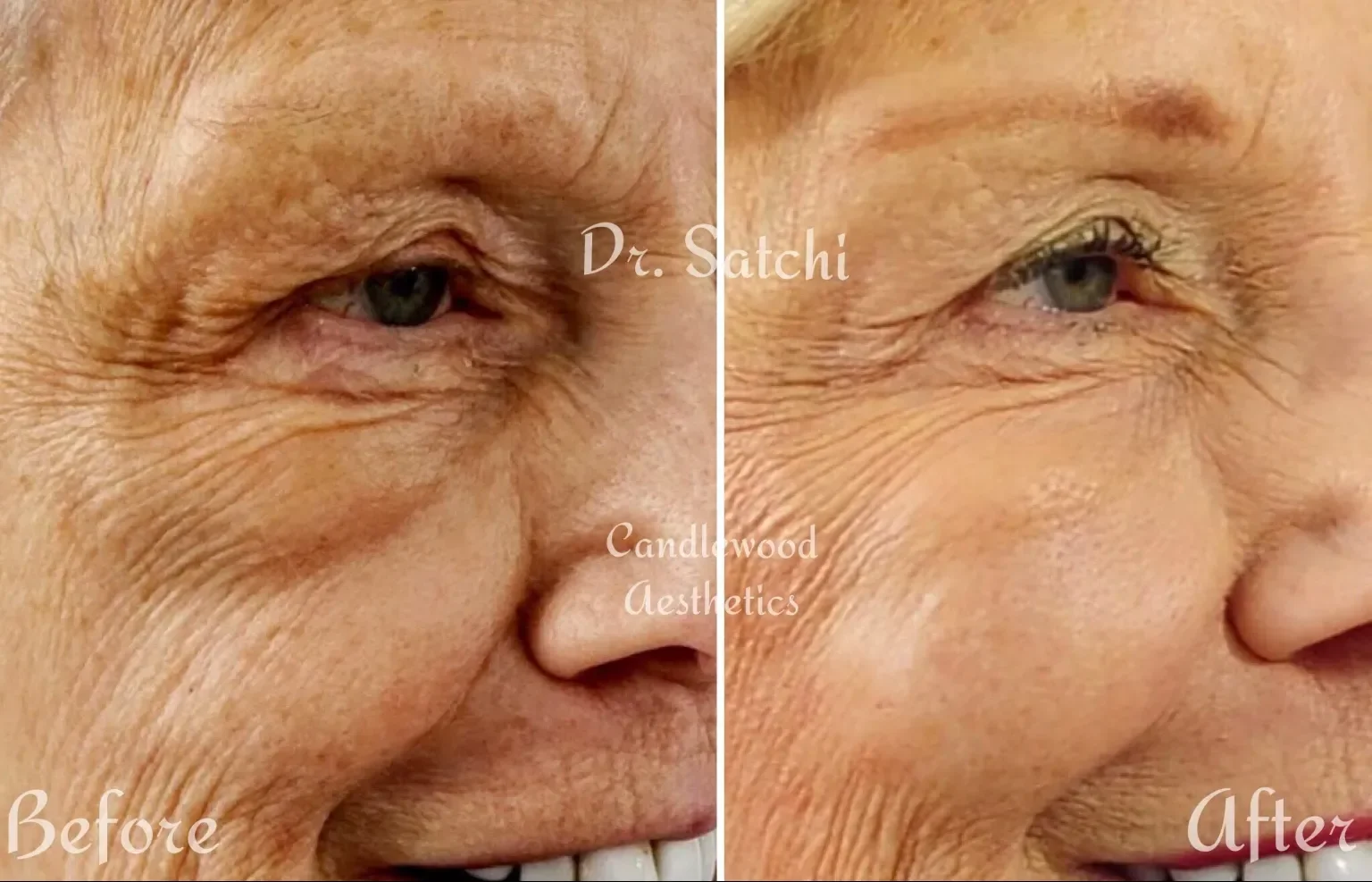 Comparison of an elderly person's eye area showing significant reduction in wrinkles and sagging after aesthetic treatment.