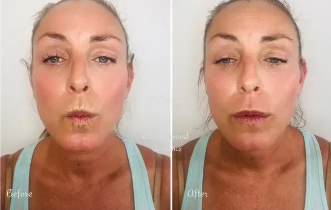 Comparison of a woman's face before and after a skincare treatment, showing smoother skin and fewer wrinkles in the after image.