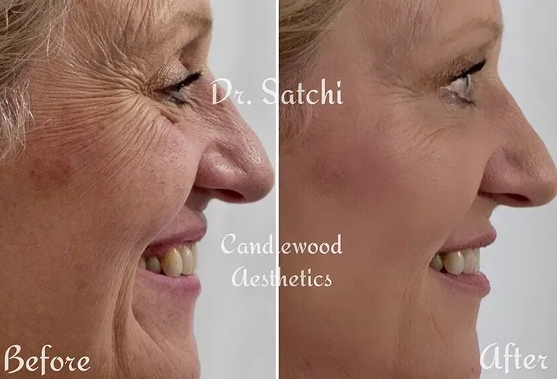 Side-by-side comparison of a woman's face before and after cosmetic treatment showing reduced facial wrinkles and smoother skin.