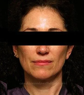 Close-up of a woman's face with dark hair, with a black bar covering her eyes, showing mild facial imperfections.