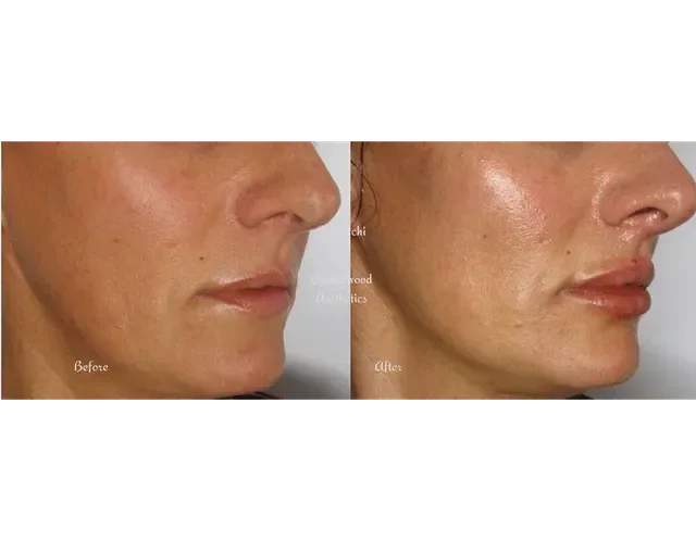 Side-by-side comparison of a woman's face showing improvements in skin texture and complexion before and after skincare treatment, with visible reduction in blemishes and smoother skin.