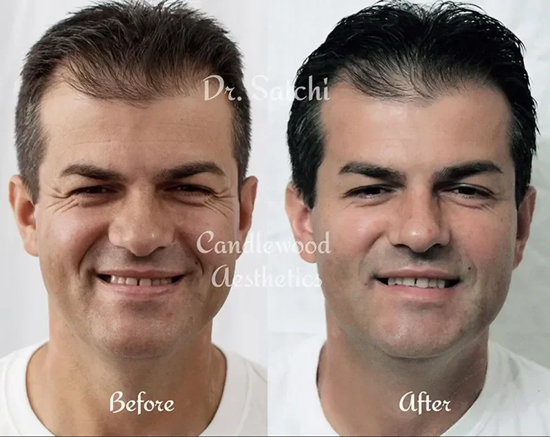 Side-by-side comparison of a man before and after cosmetic treatment, showing facial differences.