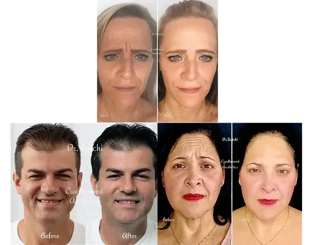 BOTOX GLABELLA