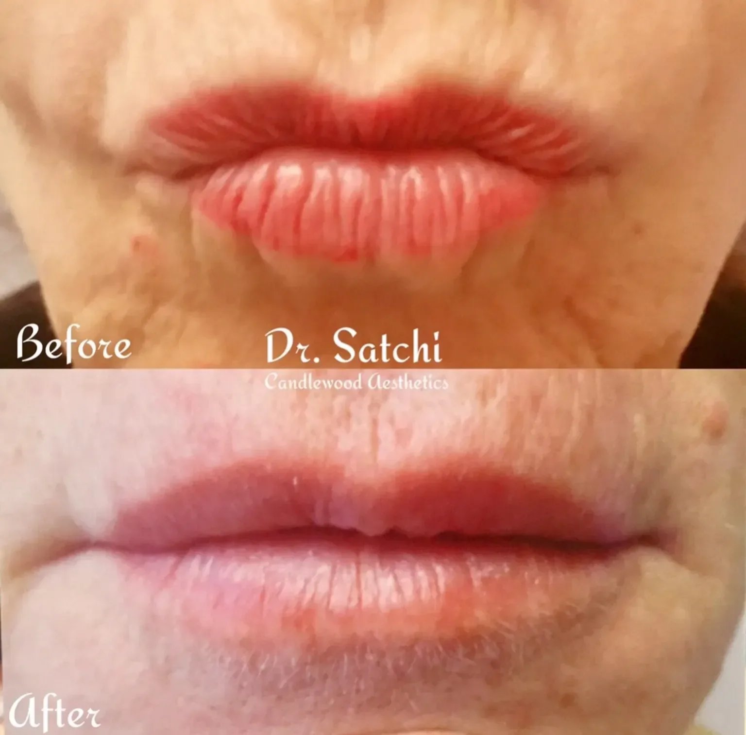 Comparison of lips before and after cosmetic treatment, showing enhanced lip volume and definition in the 'after' photo.
