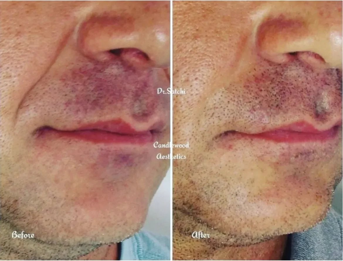 Side-by-side comparison of a man's face showing a skin treatment before and after. The left side shows inflamed, dark, and broken skin around the nose and upper lip; the right side shows clearer, healthier skin with reduced inflammation and pigmentat