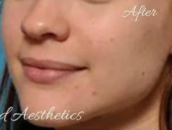 Close-up of a person's face showing clear skin with minor blemishes, with the words 'After' and 'Aesthetics' overlayed.