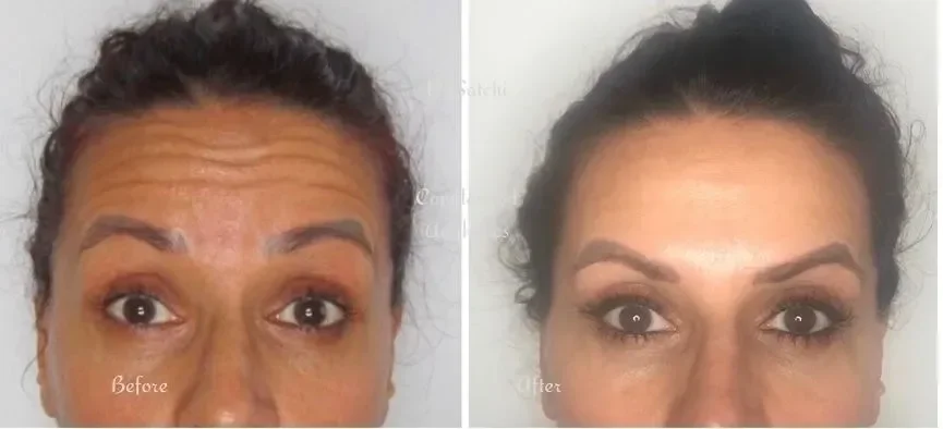Side-by-side comparison of a woman's face showing a before-and-after transformation, with the before side displaying wrinkles and uneven skin tone, and the after side showing smoother skin and improved complexion.