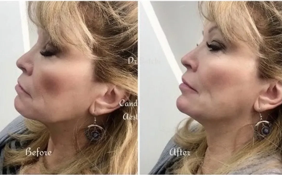 Side-by-side images showing a woman's profile before and after a cosmetic procedure, with the 'before' image on the left and the 'after' image on the right.