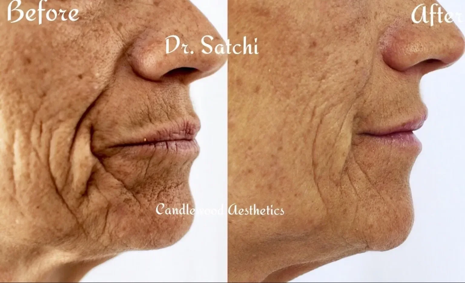 Close-up before and after photos of a person's lower face and chin showing improved skin texture and reduced wrinkles after treatment by Dr. Satchi.